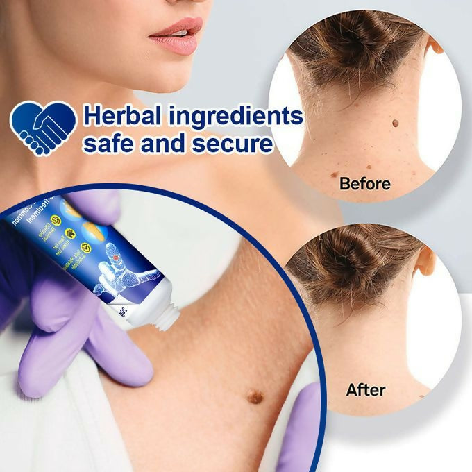 Warts Remover Ointment – Fast & Natural Treatment for Warts, Moles, Skin Tags & Corns