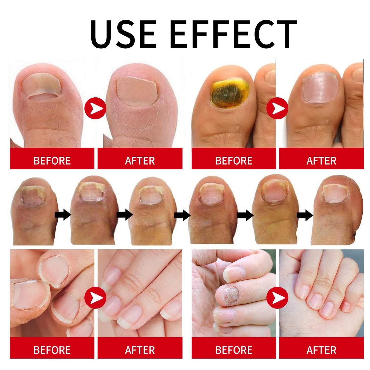 1/2/5pcs Nail Care Essence-Liquid Repairing Yellowing And Thickening Gray Nails Of Hands And Feet Nail Moisturizing Liquid 20ml