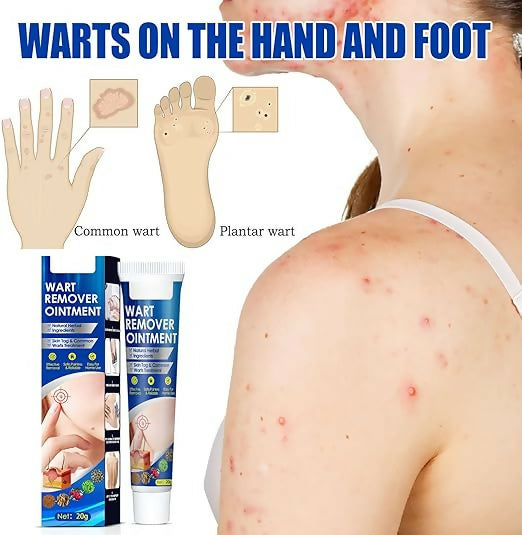 Warts Remover Ointment Warts Remover