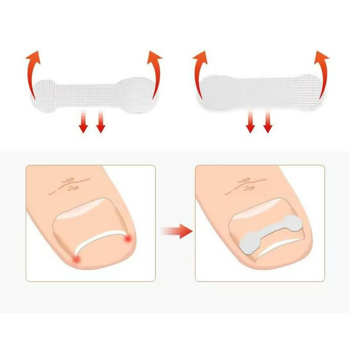 10pcs/box Ingrown Toe Nail Correction Sticker Patches