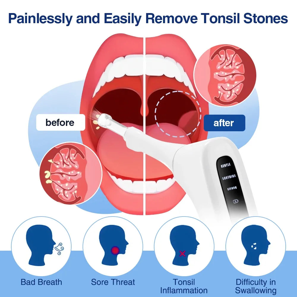Electric Vacuum Tonsil Stone Removal Kit 3-Level Suction Fight Bad Breath Instant Suction Tonsil Cleaner with UV disinfection