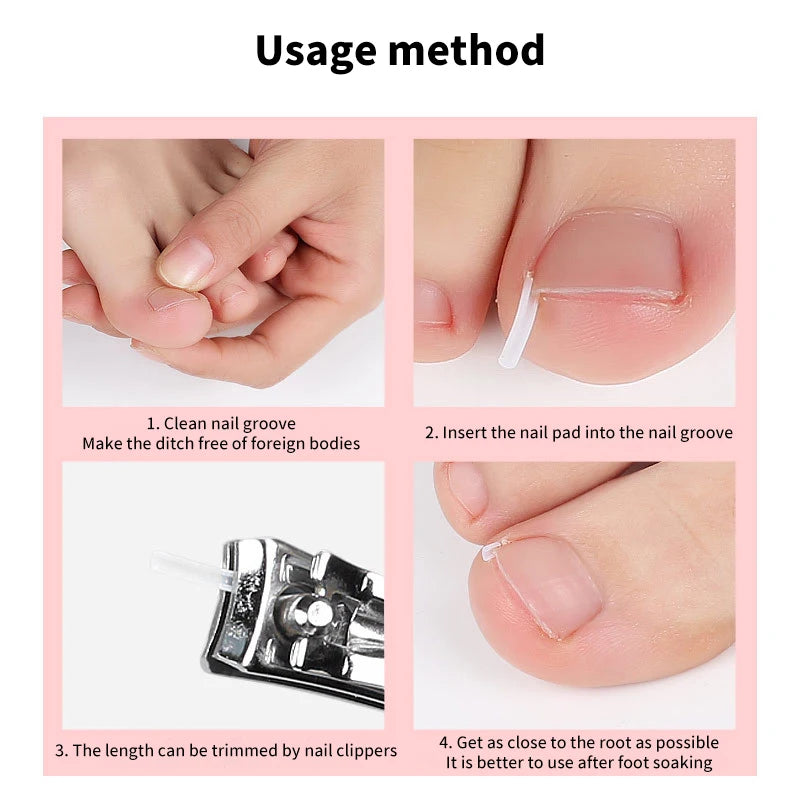 50Pcs/Box Ingrown Toenail Correction Strips Paronychia Correction Straightening Brace Toe Nail Treatment Groove Pedicure Tools