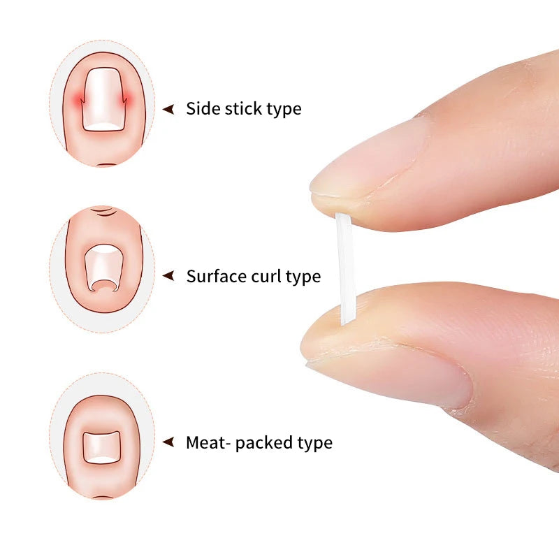 50Pcs/Box Ingrown Toenail Correction Strips Paronychia Correction Straightening Brace Toe Nail Treatment Groove Pedicure Tools