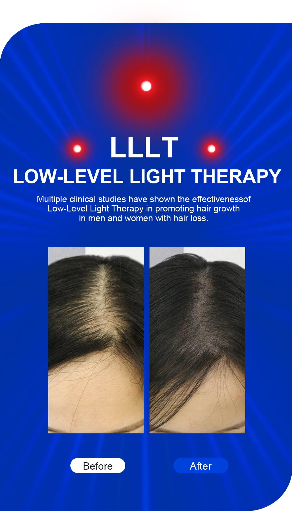 Lescolton Men Hair Growth Cap LLLT Helmet Laser Hair Regrowth Hair Loss Laser Treatment Hair Fast Growth Anti Hair Loss Device