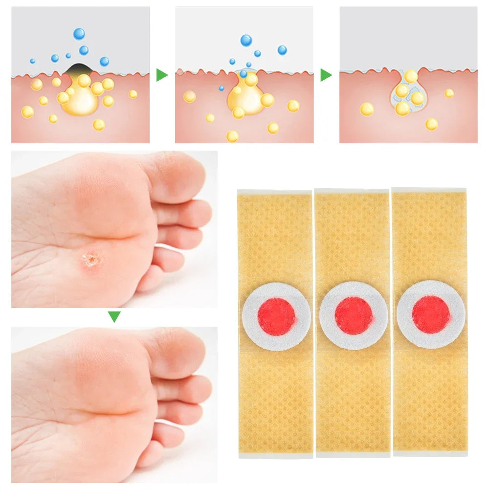 36Pcs Foot Corn Removal Plaster with Hole Warts Thorn Patch Feet Callus Remove Soften Skin Cutin Sticker Cure Toe Protector