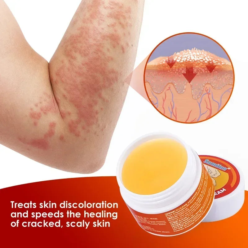 Medical Psoriasis Cream Dermatitis Eczematoid Ointment Antibacterial Anti Itching Rash Urticaria Plaster Skin Care Cream