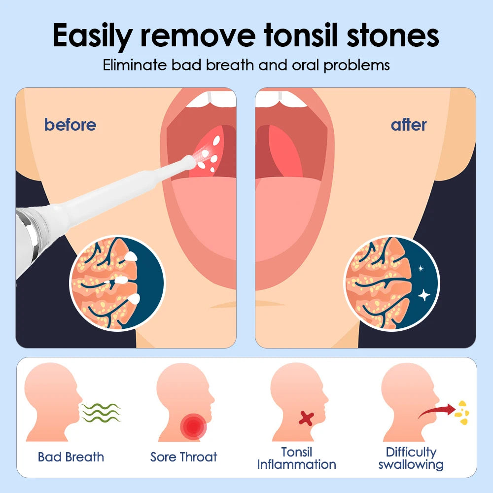 New Electronic Tonsil Stone Extractor For Oral Care Vacuum Stone Cleaning Set And Instant Suction Tool To Improve Oral Health