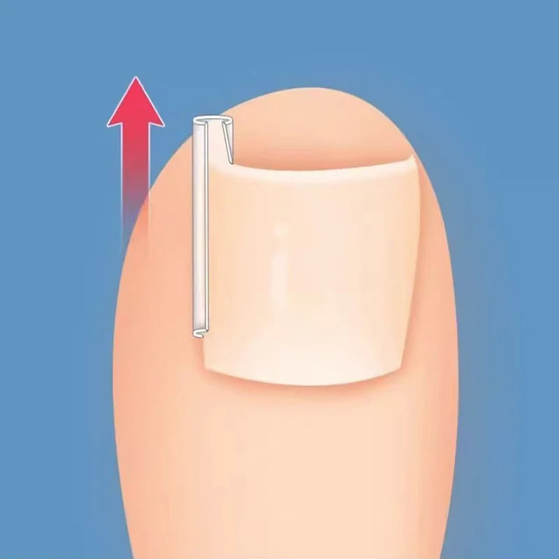 50Pcs/Box Ingrown Toenail Correction Strips Paronychia Correction Straightening Brace Toe Nail Treatment Groove Pedicure Tools