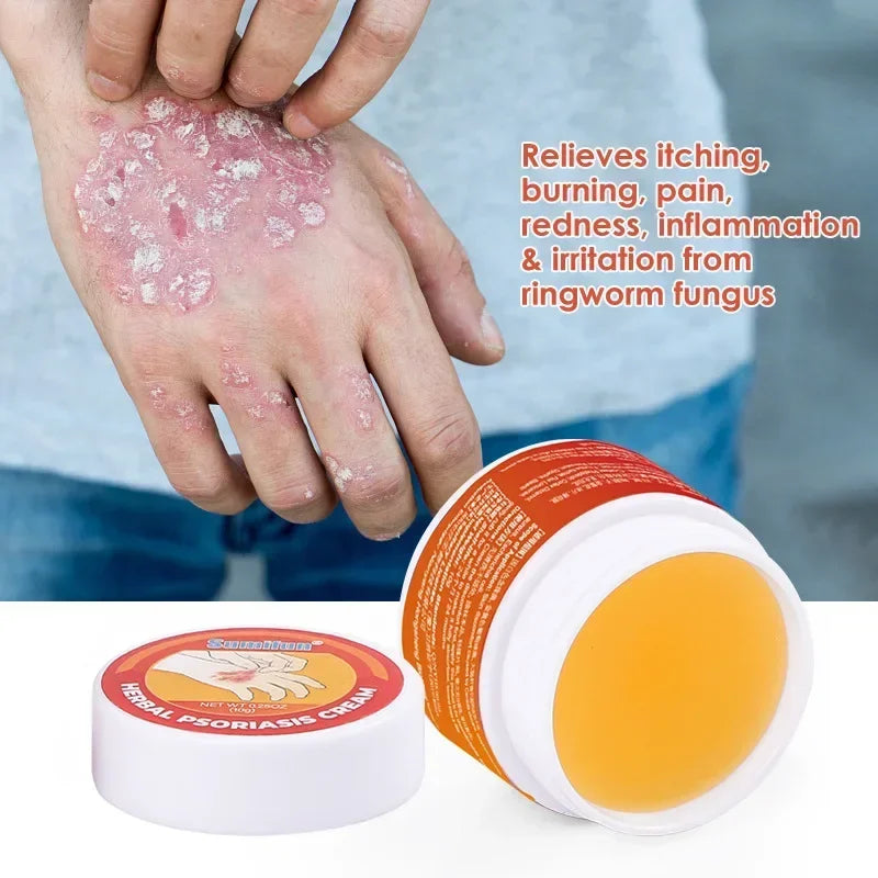 Medical Psoriasis Cream Dermatitis Eczematoid Ointment Antibacterial Anti Itching Rash Urticaria Plaster Skin Care Cream