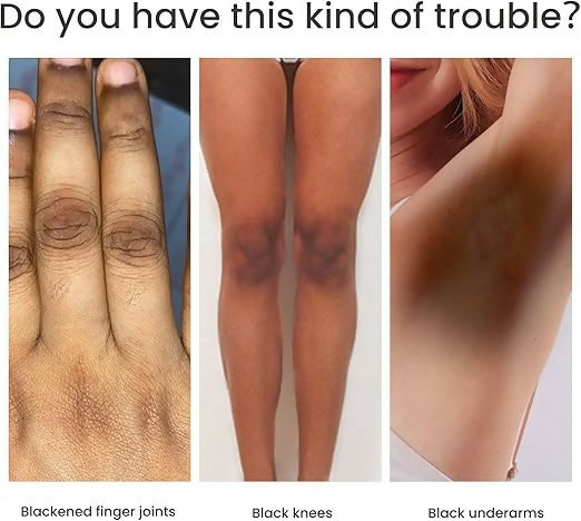 Knuckle Whitening Cream Clears Dark Knuckles & Spots- 50ML