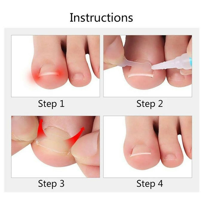 10pcs/box Ingrown Toe Nail Correction Sticker Patches