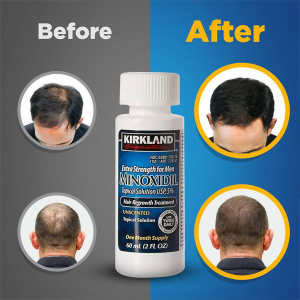 Minoxidil 5% Hair Regrowth Treatment For Men