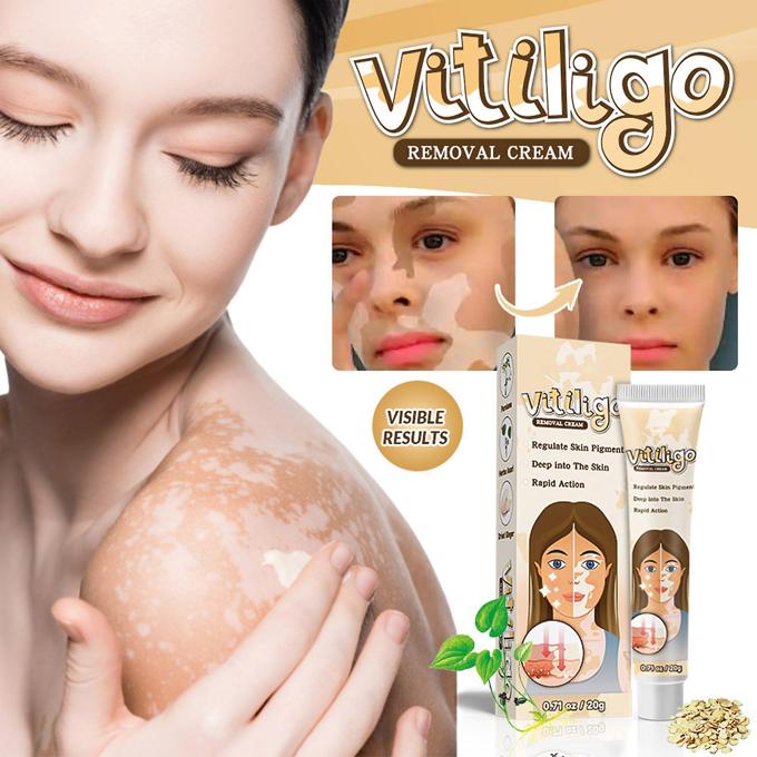 Vitiligo Removal Cleansing Cream Facial Care Ointment Skin Care, Vitiligo Care Cream, Vitiligo Removal Solutions