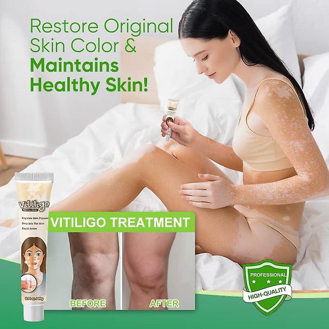 Vitiligo Removal Cleansing Cream Facial Care Ointment Skin Care, Vitiligo Care Cream, Vitiligo Removal Solutions